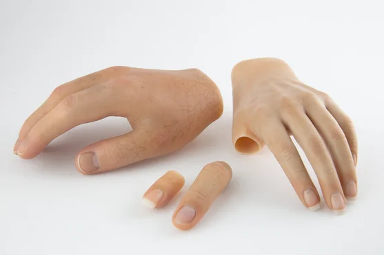Partial Hand Prostheses and Silicone Hand